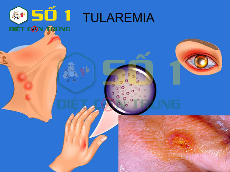 Bệnh Tularemia