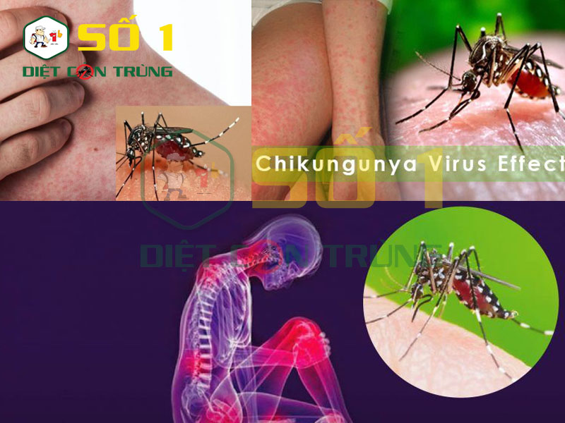 Bệnh Chikungunya